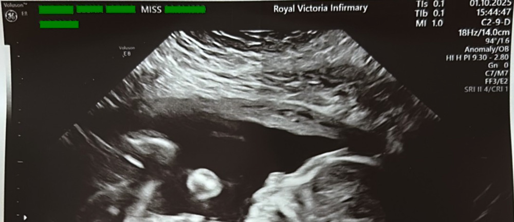 Ultrasound scan which has had the persons identity removed